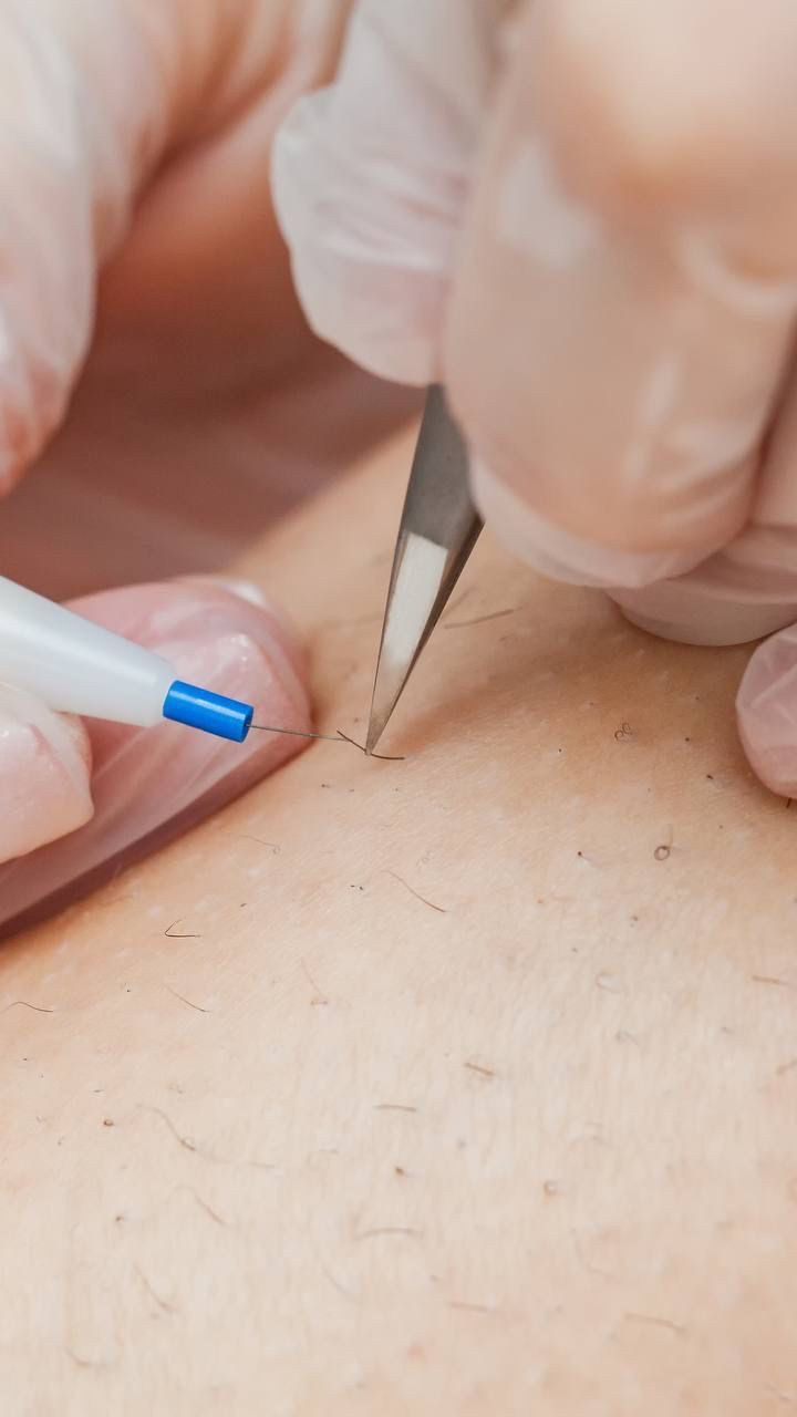 Elektrisk epilering- Permanent hårborttagning för alla hår- och hudtyper.